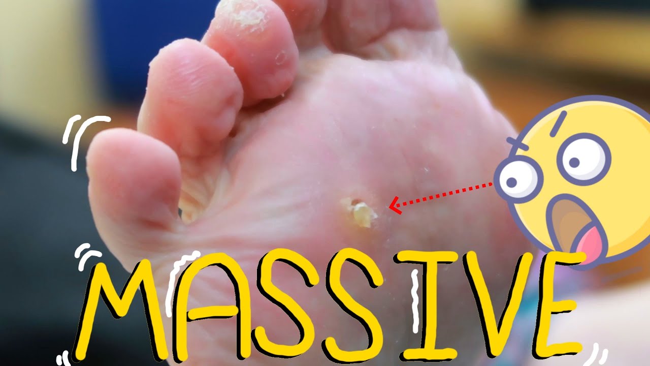 MASSIVE Corn Removal! SURPRISINGLY Satisfying YouTube