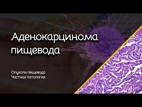 Аденокарцинома пищевода | Опухоли пищевода | Частная патология