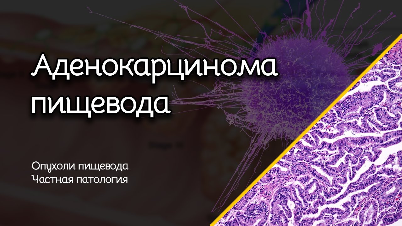 Аденокарцинома пищевода | Опухоли пищевода | Частная патология - YouTube