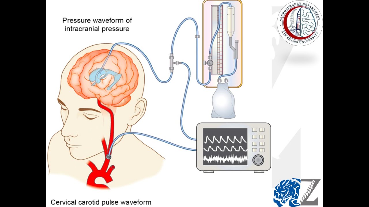 Intracranial Pressure (2):  Monitoring  ضغط المخ
