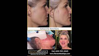 Sofwave for Skin Smoothing and Acne Scar Treatment: Susan's Experience Wealth