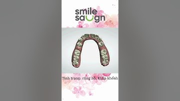 Phác đồ điều chỉnh răng hô, khấp khểnh - SmileSalign