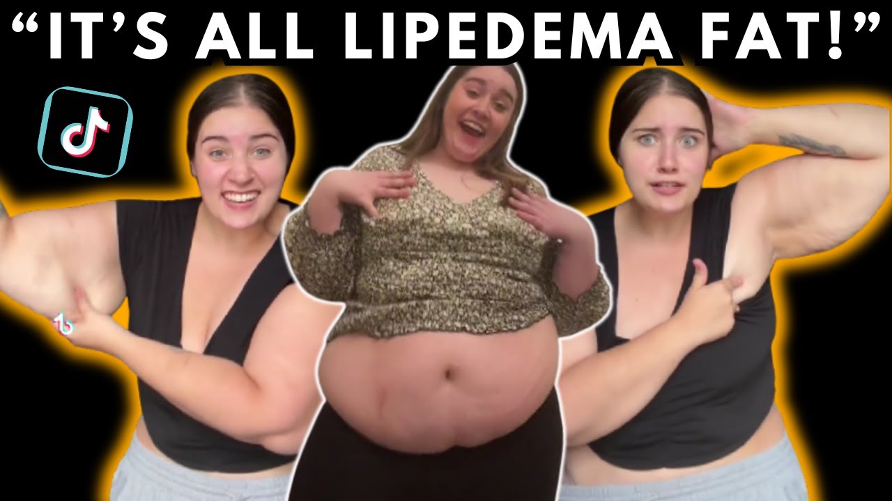 There is an ALARMING new LIPEDEMA trend on TikTok | A Chunky Mak Review