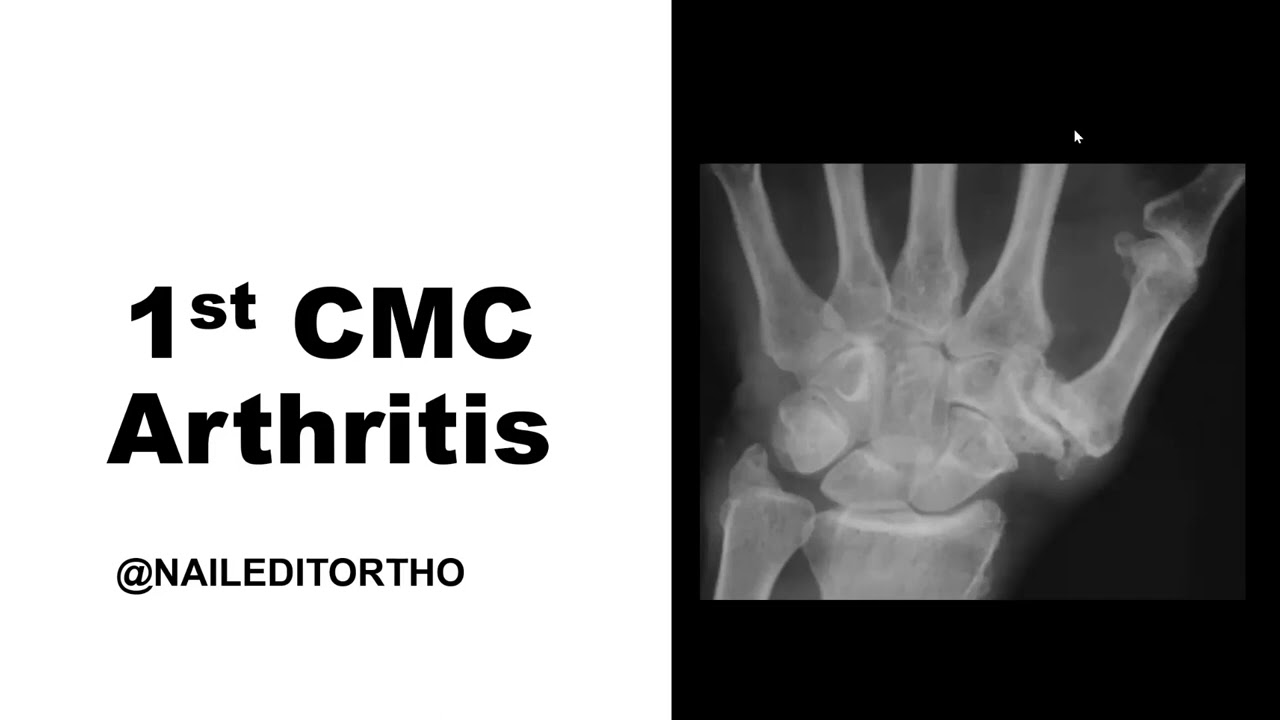 1st CMC Arthritis w/ Dr. Robert Gray – Nailed It