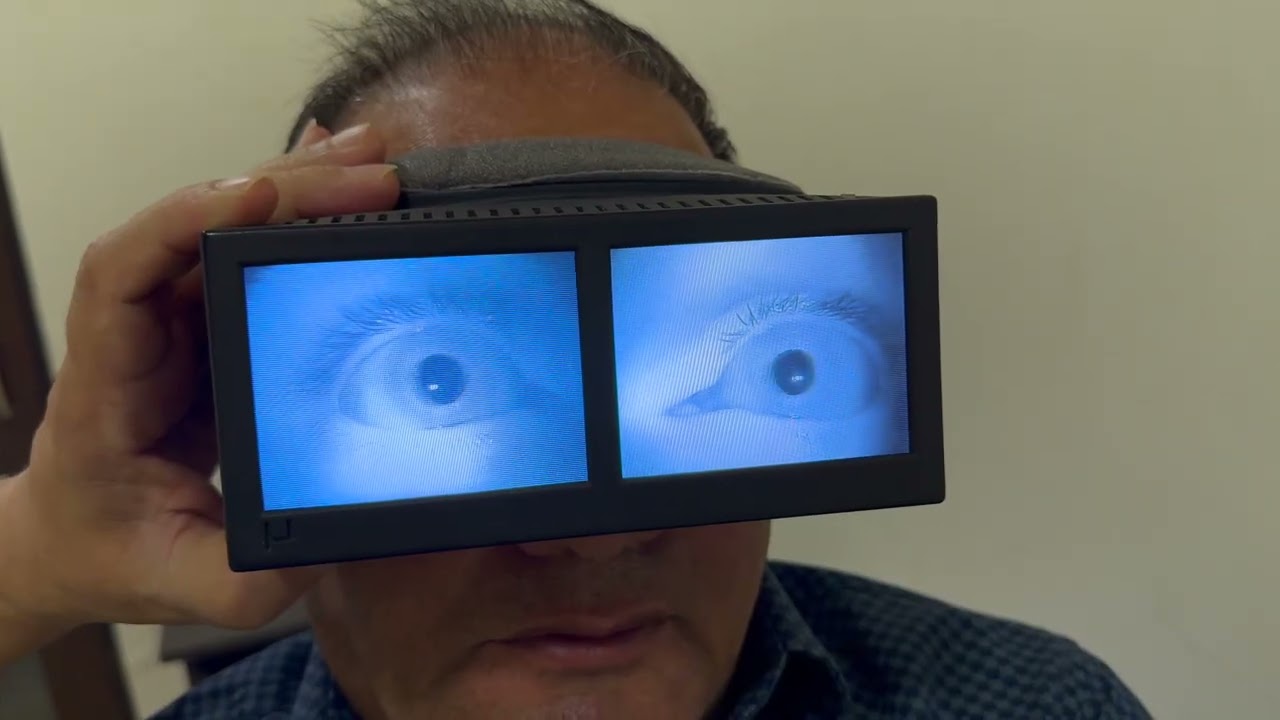 Left Short Arm Posterior Semicircular Canalolithiasis