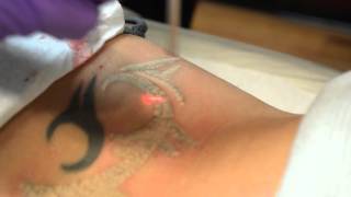 tramp stamp removal