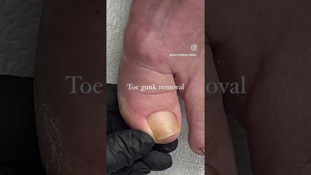 Toe Gunk Removal Satisfying Deadskin Pedicure Satisfyingvideo Toenails Cleannails