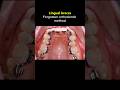 Lingual braces. The special orthodontics method #braces #orthodontist #dentist