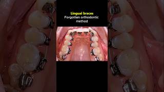 Lingual braces. The special orthodontics method #braces #orthodontist #dentist
