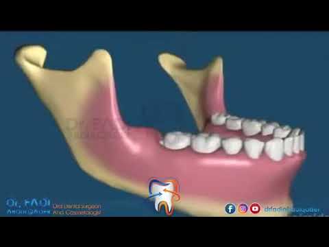 1 ضروس العقل الحلقة