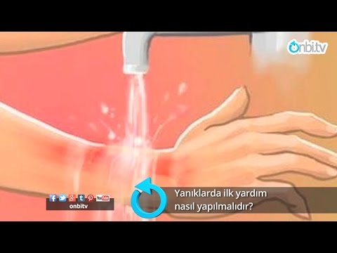 Yanıklarda ilk yardım nasıl yapılır? #yanıklardaneyapılır #yanıklardailkyardım #yanığaneiyigelir