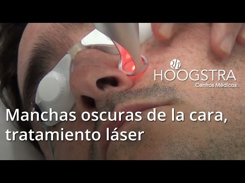 Manchas oscuras de la cara, tratamiento láser (15044)