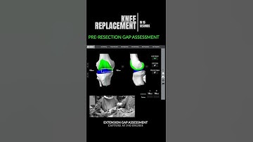 Robotic Knee Replacement Surgery - In 15 Seconds #shorts