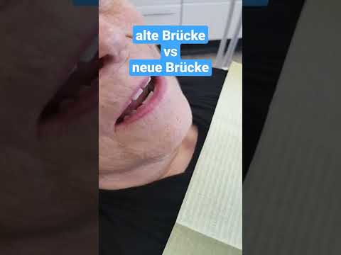 Alte Brücke vs neue Brücke - Gold Vollkeramik Zirkon