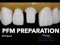 Ref:_5q440YpPd0 Pfm preparation for #8 kilgore | stevenson dental solutions