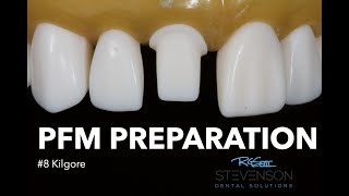 PFM Preparation for #8 Kilgore | Stevenson Dental Solutions