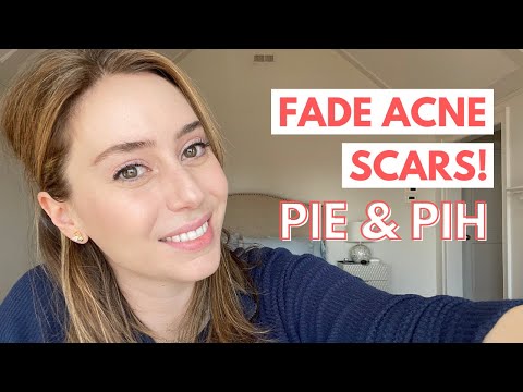 How To Fade Acne Scars: Post Inflammatory Erythema & Post Inflammatory Hyperpigmentation