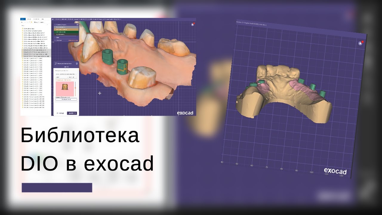 Библиотеки DIO в Exocad