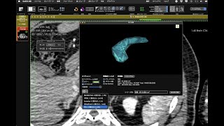 OsiriXで臓器ポリゴン書き出しの時短裏技：[ROI]-[ROI容積を計算]-[STL書き出し]