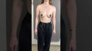 Симметризация и подтяжка груди без имплантов #shorts #пластическийхирург