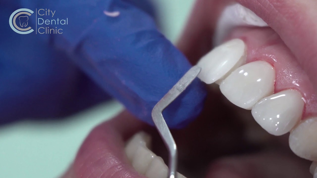 Krásne biele zubné fazety v Bratislave