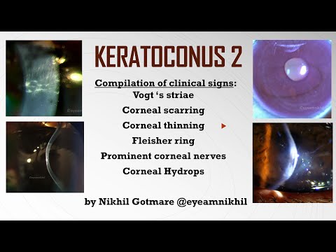 Video: Central Corneal Regularization (CCR): Een Alternatieve Benadering Bij De Behandeling Van Keratoconus
