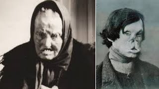 The Horrifying History of Leprosy | The Disease That Terrified Humanity