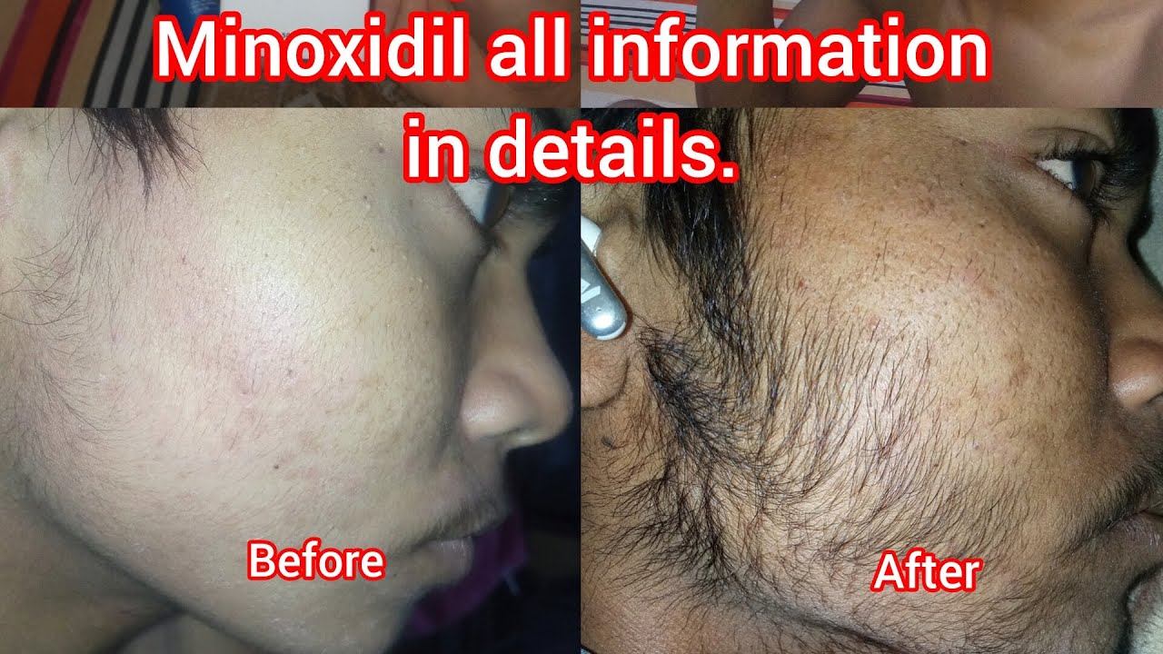 My secret beard growth tips share with you | minoxidil user don't repeat my mistake 