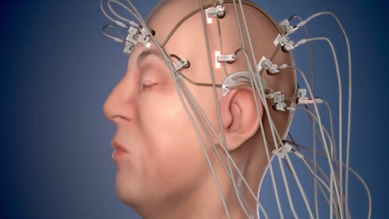 ԷԷԳ հետազոտություն. էպիլեպսիայի ախտորոշման կարևոր քայլը