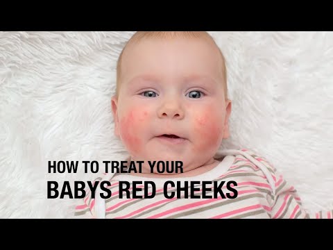 How to treat your baby's red cheeks?