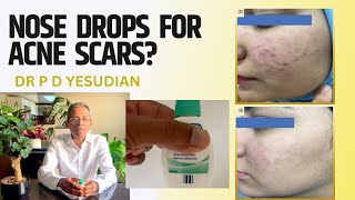 Nose drops for acne scars? Topical Oxymetazoline for post-acne scars