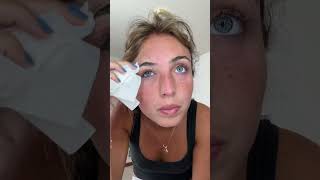 Kate I Would Still Recommend Using Calamine Lotion But Heyyy It Lowkey Worked