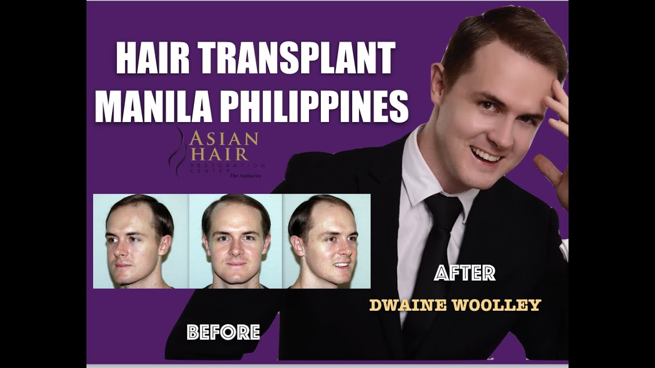 Hair Transplant Manila Philippines | 