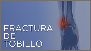 FRACTURA DE TOBILLO. Todo lo que tienes que saber: #causas, #síntomas y #tratamiento