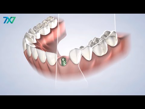 CBCT Scanning in San Francisco, CA | 7x7 Dental Implant & Oral Surgery Specialists