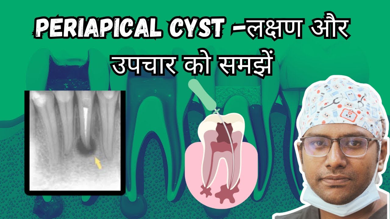 Dr Rudra Mohan | लक्षण और उपचार को समझें PERIAPICAL / RADICULAR CYST- Daant ke infection se Swelling