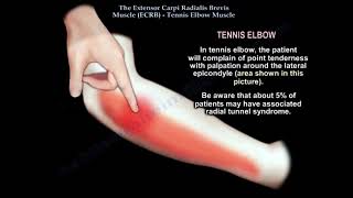 Tennis Elbow Clinical and Anatomical Considerations. The tennis elbow muscle.