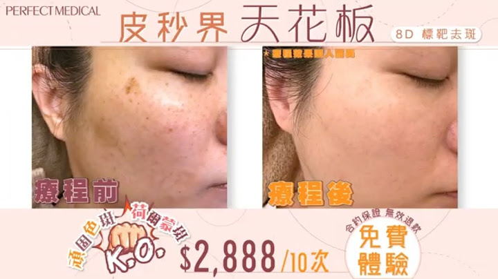 【😍免費體驗😍】莊思敏去斑首選👑去斑方法大盤點！去色斑最天然有效的方法？ - 天天要聞