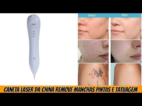 Vídeo: Qual laser para remoção de toupeira?