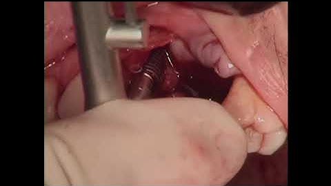 Simplified ridge and sinus augmentation using StickyboneTM(2010)  and Sohn