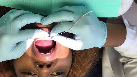 Flossing a fixed retainer