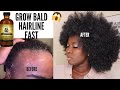 HOW TO GROW BACK BALD EDGES ALOPECIA.BALDNESS SHEDDING 3 TIMES UNSTOPPABLE FASTER