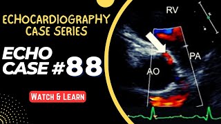 ECHO CASE 88 | Echocardiography Case Series | Echocardiogram Interpretation | 2D Echo Basics