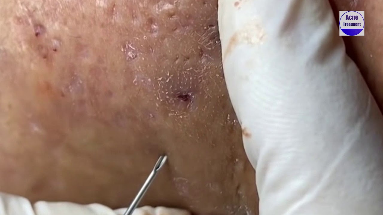 Best Pimple Popping Videos Large Blackheads Remove Blackheads Ep 24 - YouTube