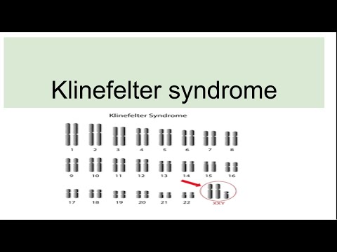 Klinefelter Syndrome Chart