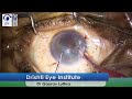 Live Cataract Surgery by Dr. Gaurav Luthra – iSert IOL Implantation