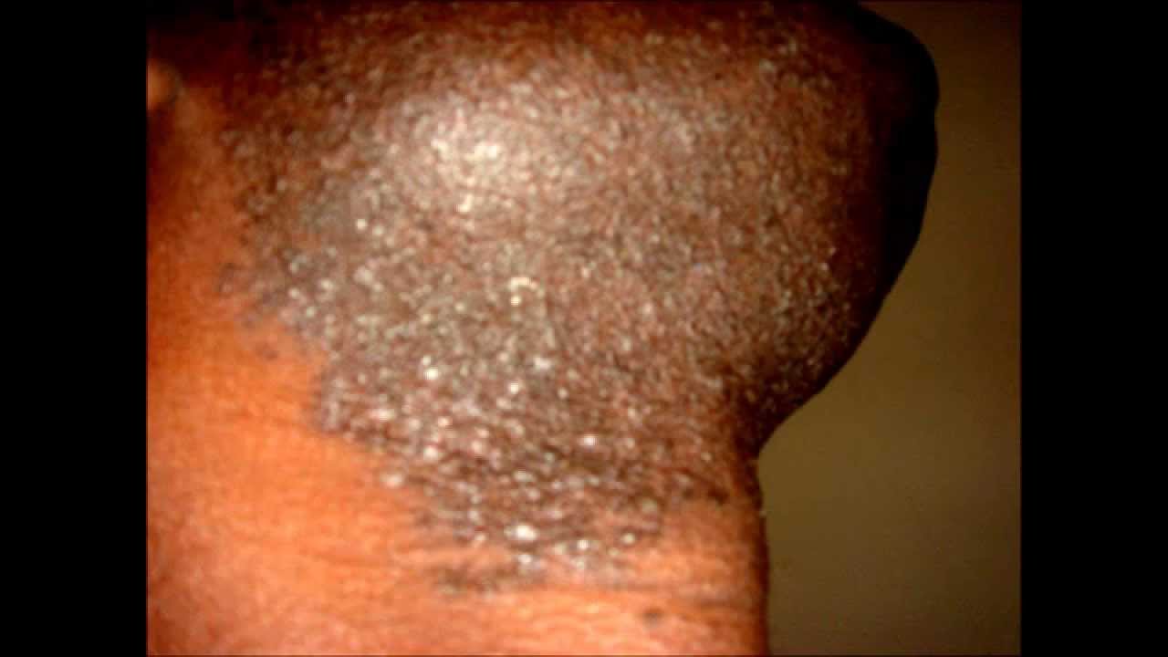 Gross Pictures Of Ingrown Hair Bruts Photos Poils Incarnes Youtube
