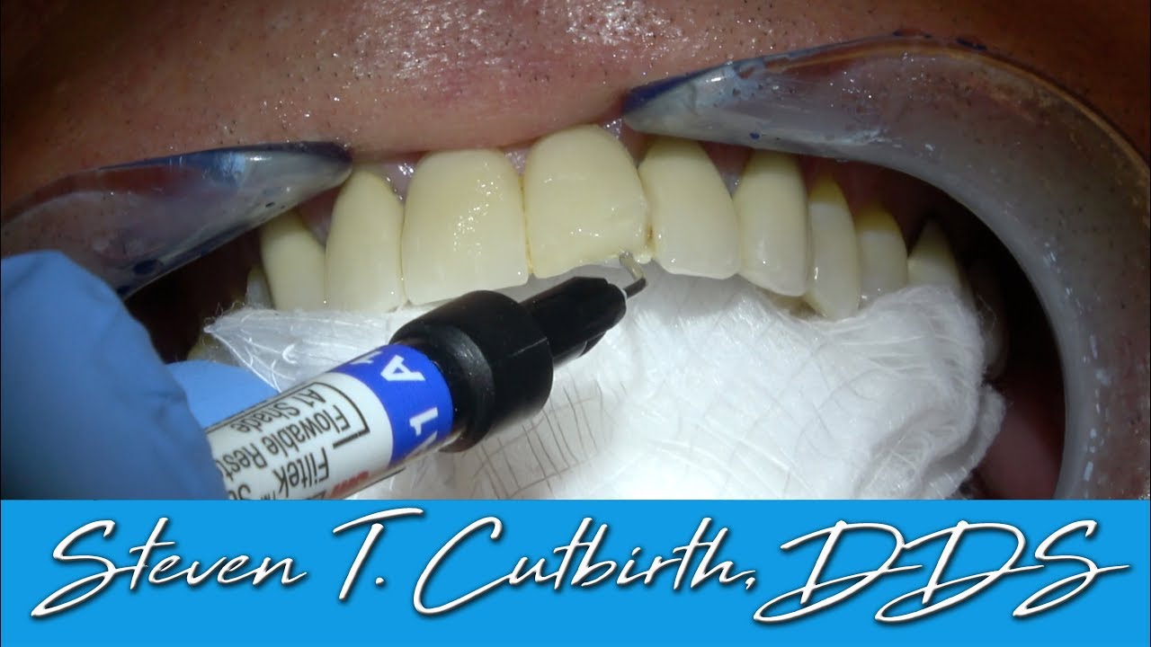 Damaged Tooth Repair: Porcelain Crown