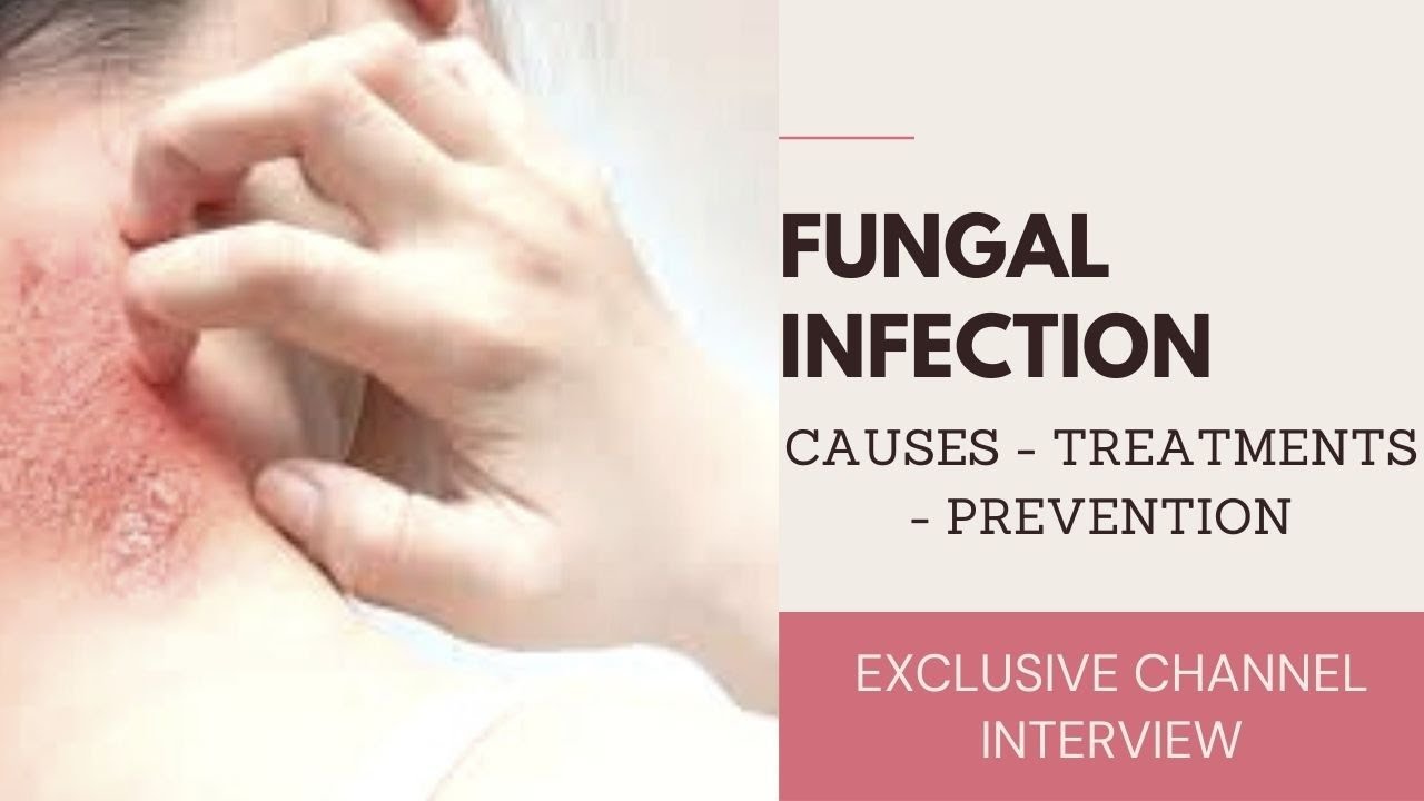 Ring worm Fungal infection. Causes, Treatments, Precautions. ringworm