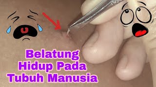 Belatung Hidup Di Tubuh Manusia